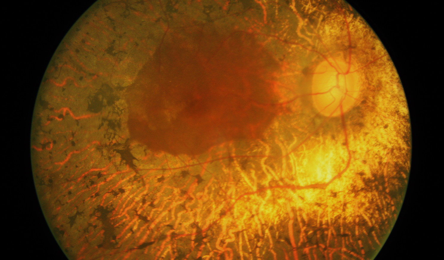 Glaucome et DMLA dépistage et suivi de la santé visuelle